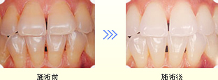 【ホワイトニング】施術前/施術後